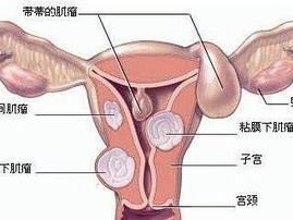 子宫切除术后梅小青因子宫肿瘤康复之路